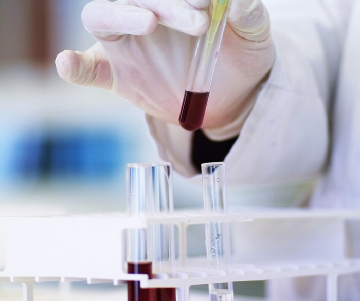 A close up of a researcher using a pipette inside a vial of blood cancer, in a rack with other vials of blood.