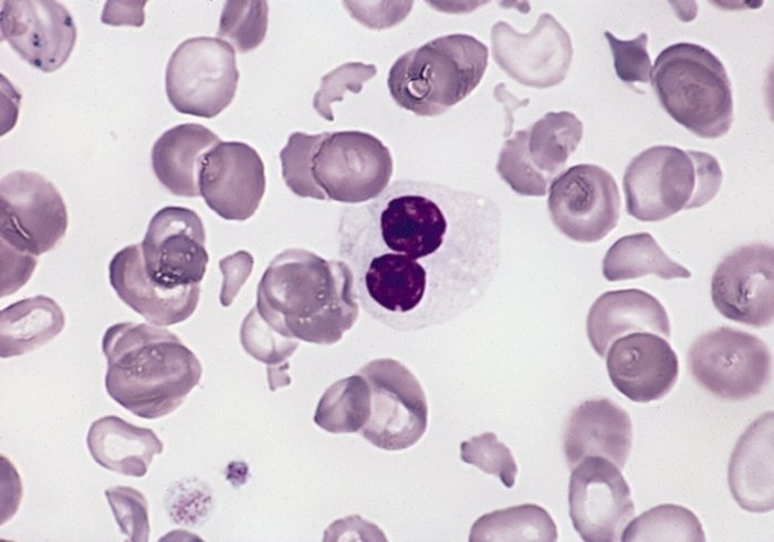 MDS cells under a microscope