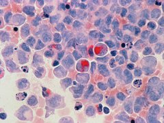 Acute myelocytic leukaemia (AML)